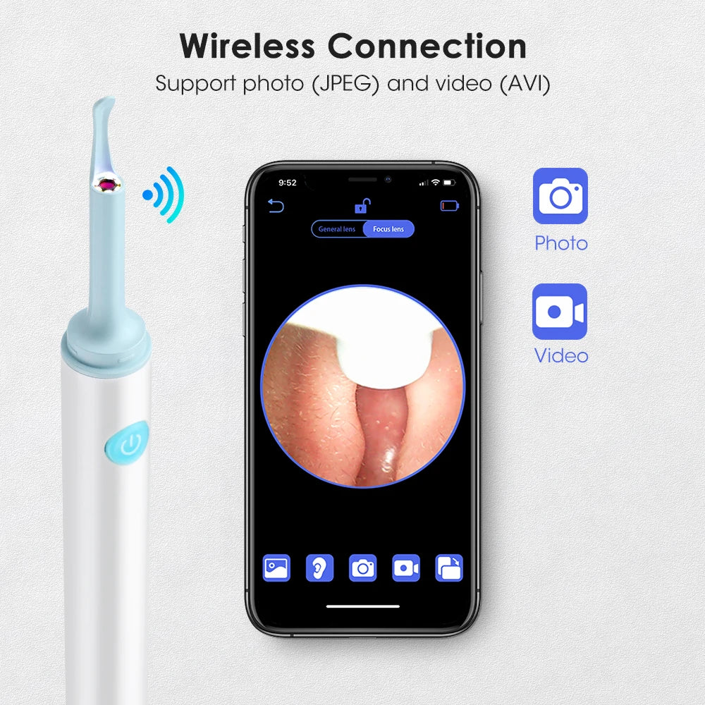 Otocam™ Limpieza de Oídos con camara Inteligente - 50% DESCUENTO HOY